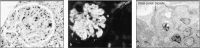 Figure 13.13. Deposition of immune complexes in the renal glomerulus causes renal failure in systemic lupus erythematosus (SLE).