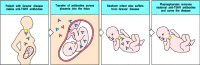 Figure 13.17. Antibody-mediated autoimmune diseases can appear in the infants of affected mothers as a consequence of transplacental antibody transfer.